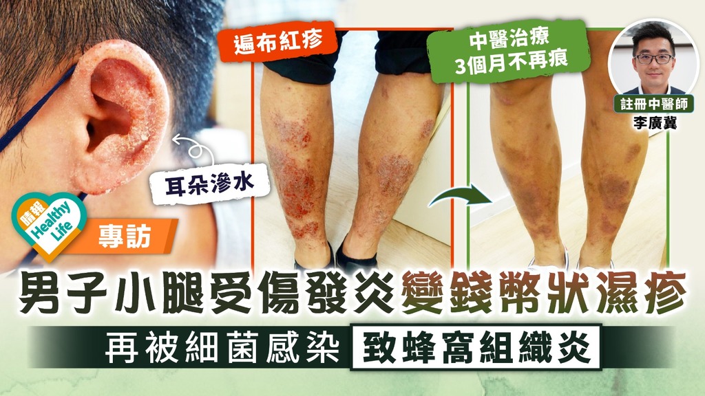 皮膚問題︳男子小腿受傷發炎變錢幣狀濕疹 再被細菌感染致蜂窩組織炎