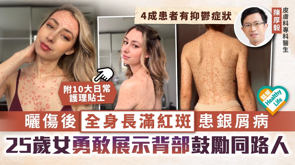 皮膚問題︳曬傷後全身長滿紅斑患銀屑病 25歲女勇敢展示背部鼓勵同路人