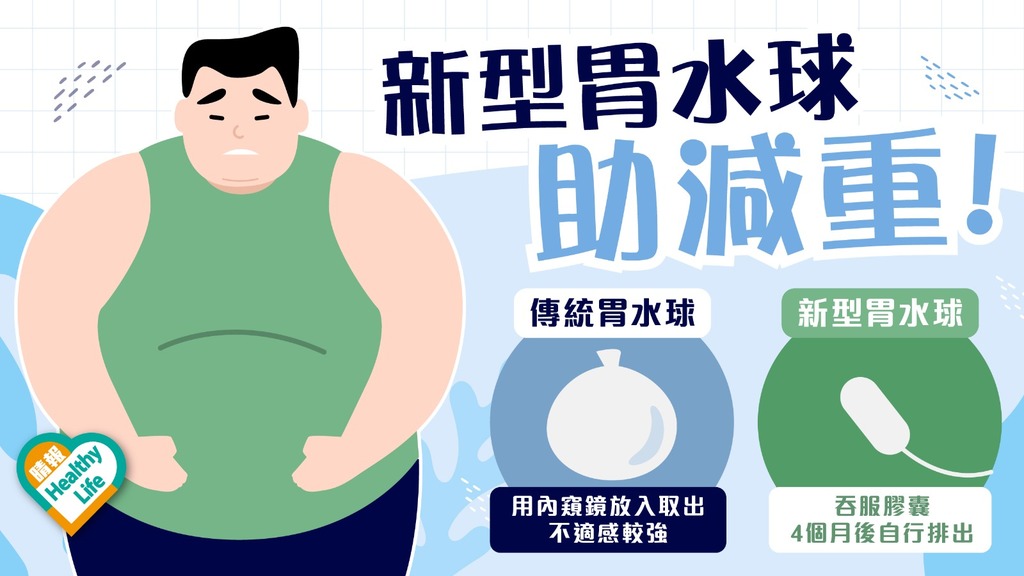 減肥有法︳新型胃水球減重治療 毋須麻醉及內窺鏡 自動排出體外