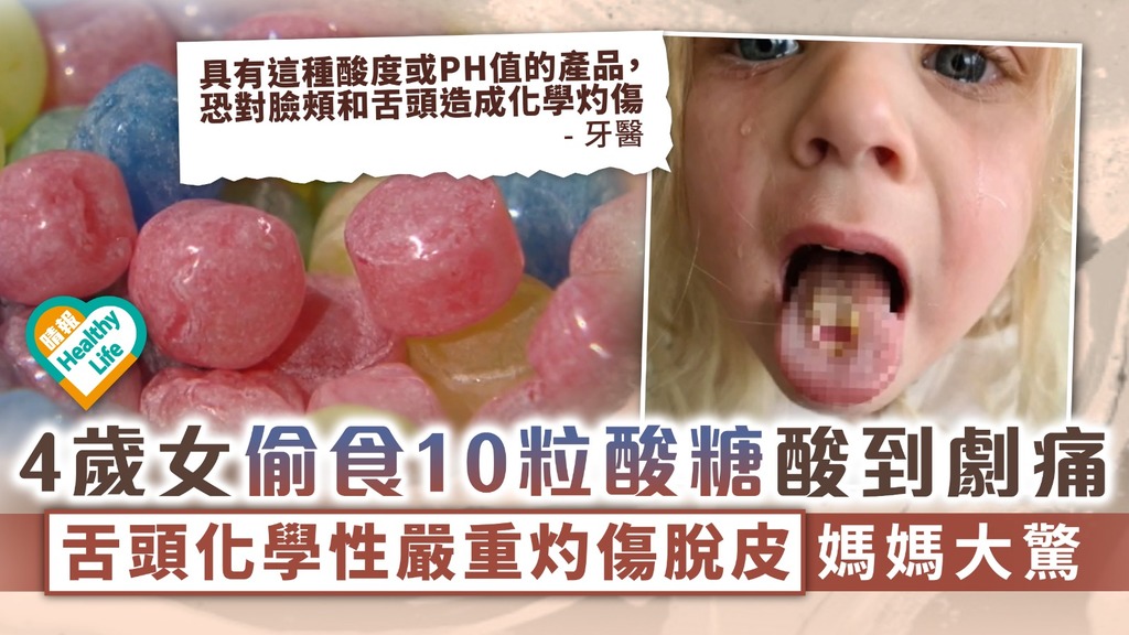家長注意︳4歲女偷食10粒酸糖酸到劇痛 舌頭化學性嚴重灼傷脫皮媽媽大驚