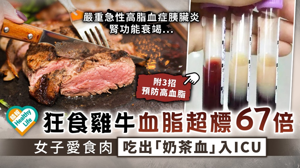 高脂飲食︳狂食雞牛血脂超標67倍 女子愛食肉吃出「奶茶血」入ICU︳附3招預防高血脂