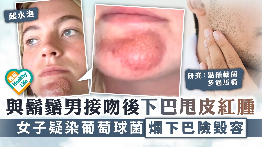 個人衛生｜與鬍鬚男接吻後下巴甩皮紅腫 疑染葡萄球菌女子險毀容