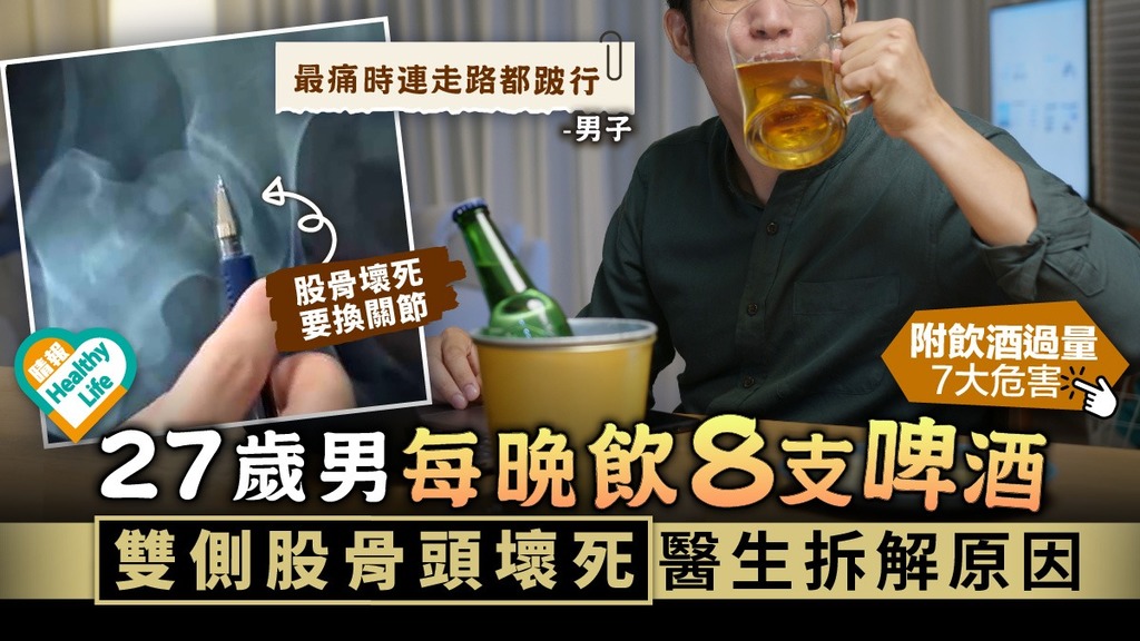 不良習慣︳27歲男每晚飲8支啤酒 雙側股骨頭壞死醫生拆解原因︳附飲酒過量7大危害