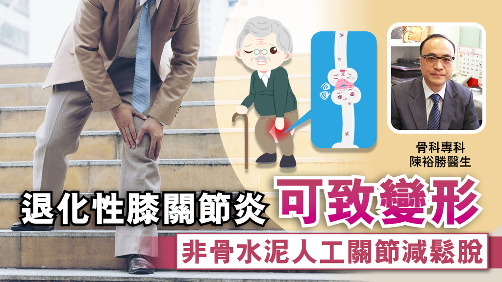 退化性膝關節炎可致變形 非骨水泥人工關節減鬆脫