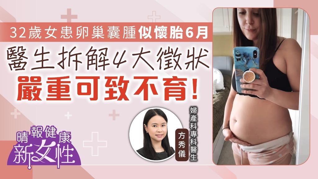 健康新女性︳32歲女患卵巢囊腫似懷胎6月 醫生拆解4大徵狀嚴重可致不育