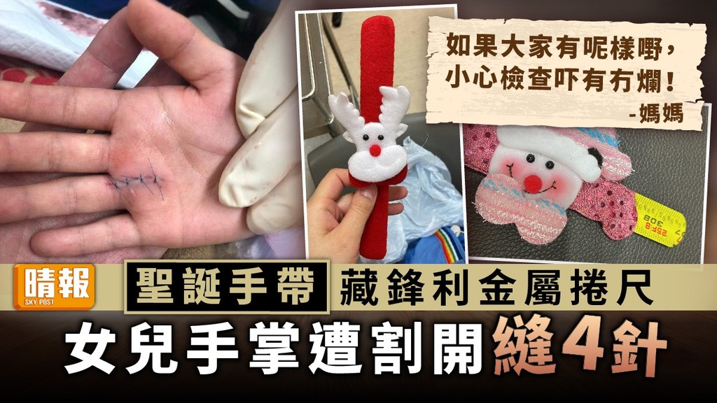 聖誕危機 ︳聖誕手帶藏鋒利金屬捲尺 女兒手掌遭割開縫4針