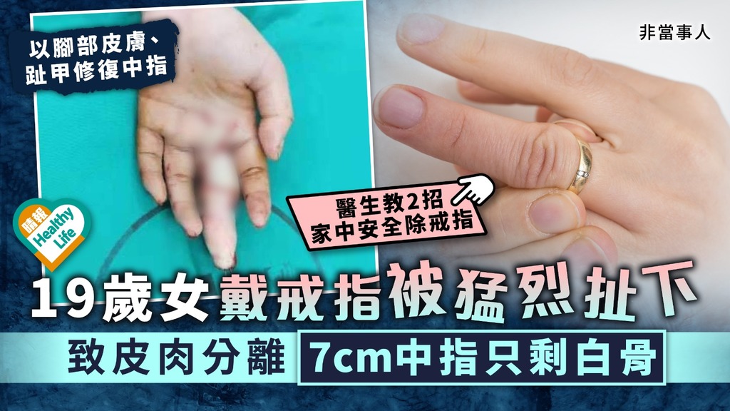 恐怖意外︳19歲女戴戒指被猛烈扯下 致皮肉分離7cm中指只剩白骨︳附4招安全除戒指
