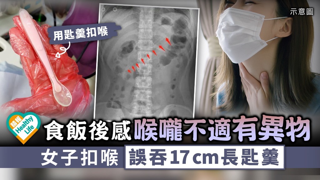 誤吞異物｜食飯後感喉嚨不適有異物 女子扣喉誤吞17cm長匙羹｜預防誤吞異物5大貼士