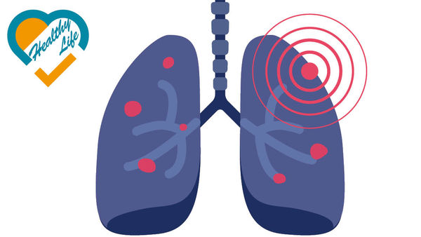 不吸煙患肺癌趨年輕化 倡高危族低劑量掃描篩查