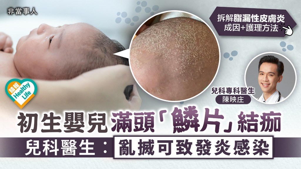 嬰兒皮膚︳初生嬰兒滿頭「鱗片」結痂 兒科醫生︰亂搣可致發炎感染︳附脂漏性皮膚炎成因