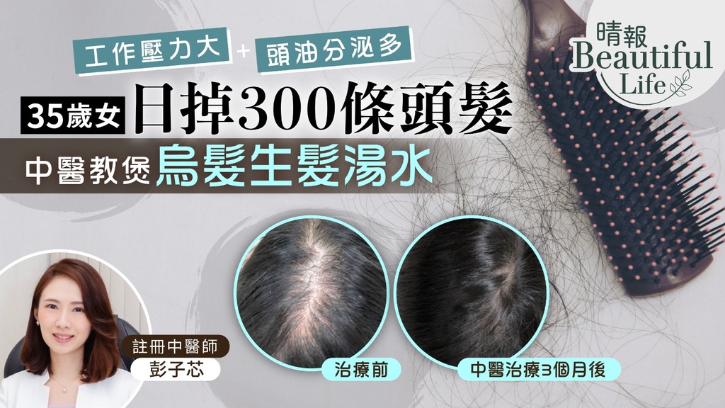 Beautiful Life︳35歲女工作壓力大日掉300條頭髮 頭油分泌旺盛中醫治療3個月回復濃密︳附生髮湯食譜