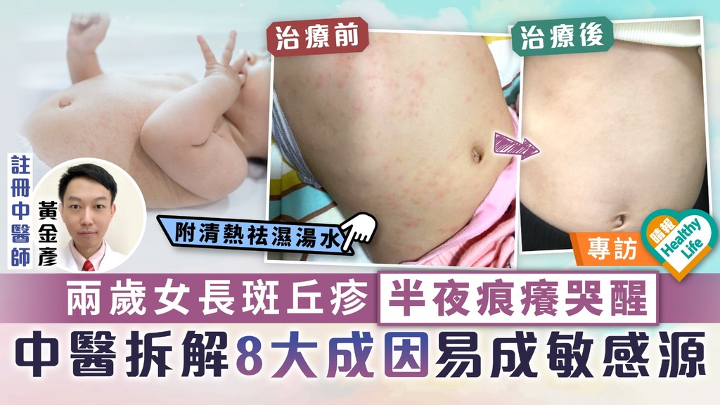 嬰幼兒皮膚︳兩歲女長斑丘疹半夜痕癢哭醒 中醫拆解8大成因易成敏感源︳附清熱祛濕湯水
