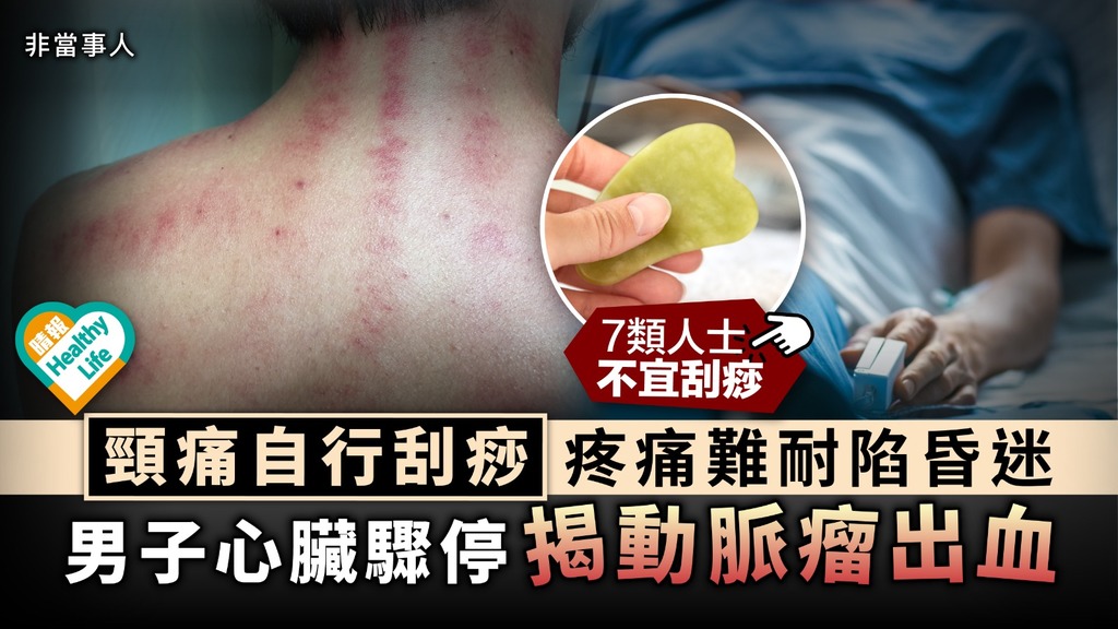 偏方治療︳頸痛自行刮痧疼痛難耐陷昏迷 男子心臟驟停揭動脈瘤出血︳附7類不宜刮痧人士