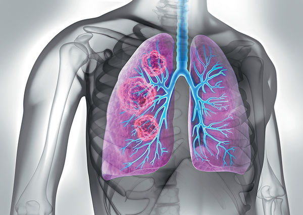 港肺癌近10年發病率 女升男跌50歲以下更明顯