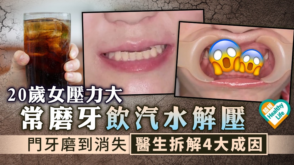 長期磨牙︳20歲女壓力大常磨牙飲汽水解壓 門牙磨到消失醫生拆解4大成因
