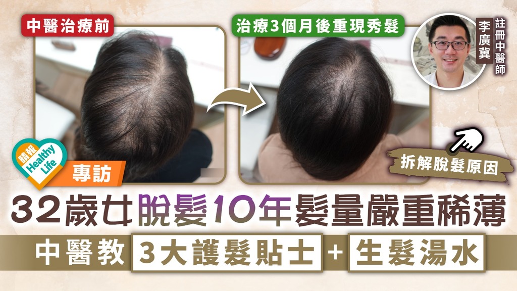 脫髮困擾︳32歲女脫髮10年髮量嚴重稀薄 中醫教3大護髮貼士＋生髮湯水
