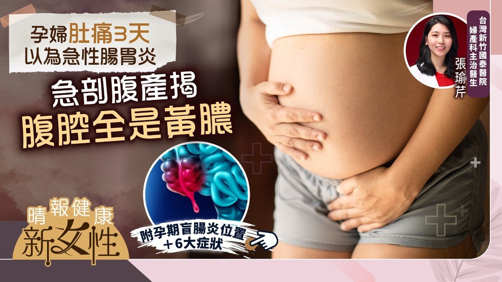 健康新女性︳孕婦肚痛3天以為急性腸胃炎 急剖腹產揭腹腔全是黃膿︳附孕期盲腸炎位置+6大症狀
