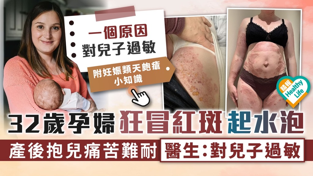 罕見過敏︳32歲孕婦狂冒紅斑起水泡 產後抱兒痛苦難耐 醫生：對兒子過敏︳附妊娠類天皰瘡小知識