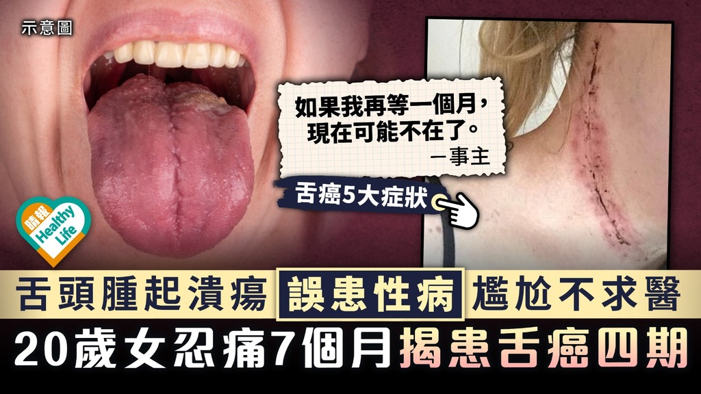 口腔癌︳舌頭腫起潰瘍誤患性病尷尬不求醫 20歲女忍痛7個月揭患舌癌四期︳附舌癌5大症狀