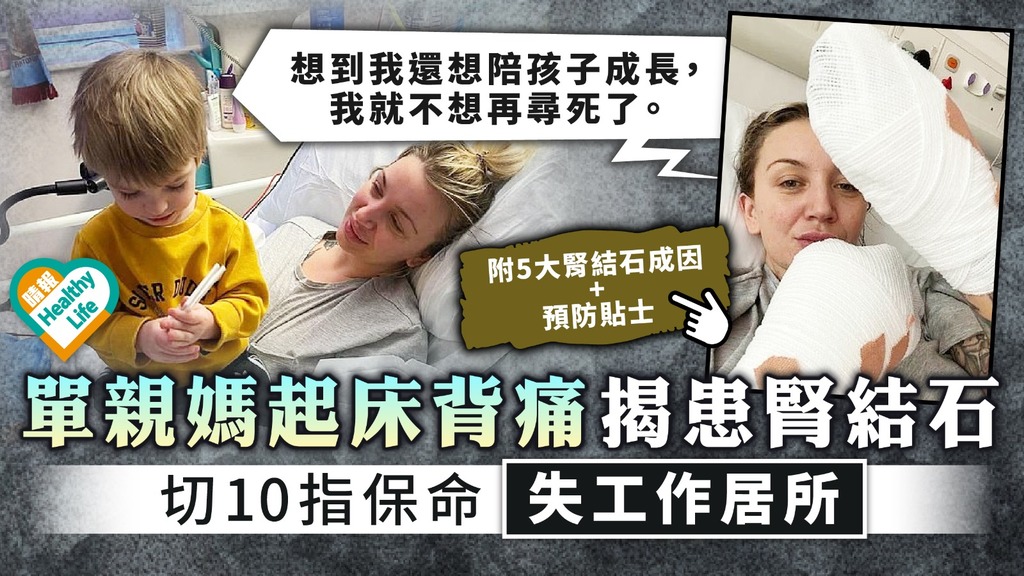 敗血症︳單親媽腎結石惡化致敗血症 切除10指保命失去工作居所︳附5大腎結石成因+預防貼士