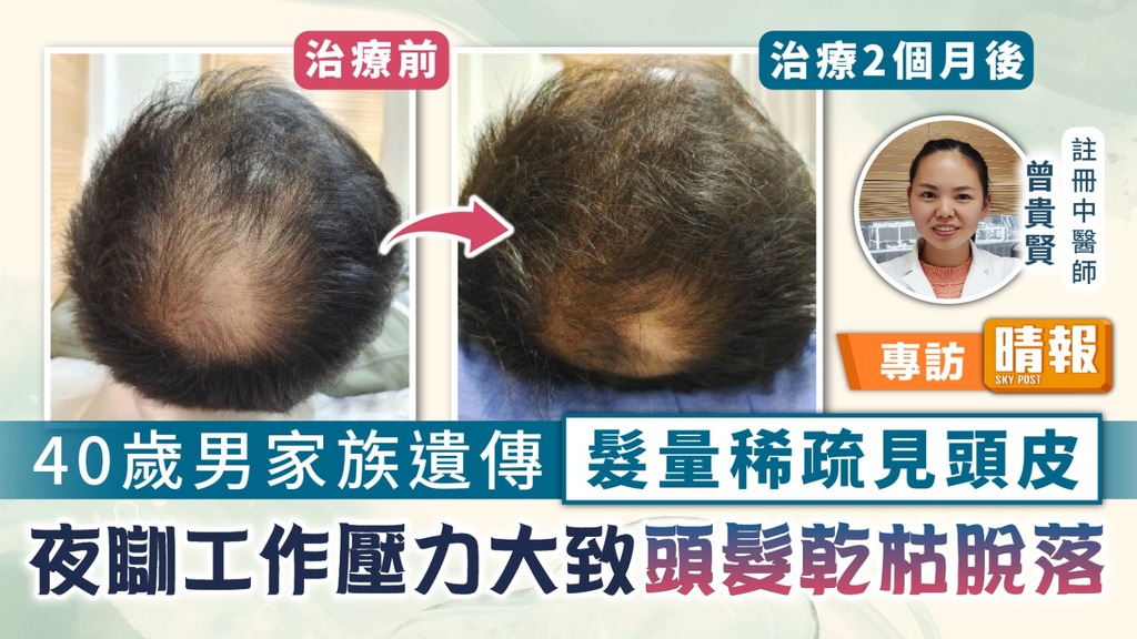 男士脫髮︳40歲男家族遺傳髮量稀疏見頭皮 夜瞓工作壓力大致頭髮乾枯脫落