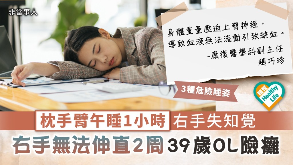 錯誤睡姿｜枕手臂午睡1小時右手失知覺 右手無法伸直2周39歲OL險癱｜附3種危險睡姿