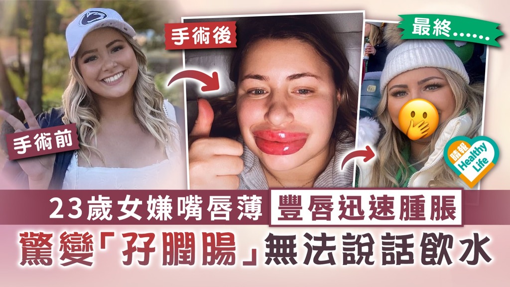 整容危機︳23歲女嫌嘴唇薄豐唇迅速腫脹 驚變「孖膶腸」無法說話飲水
