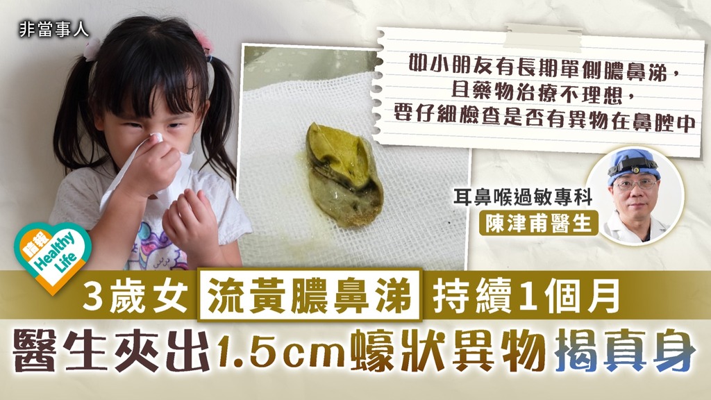 家長注意︳3歲女流黃膿鼻涕持續1個月 醫生夾出1.5cm蠔狀異物揭真身︳附5大高危物品