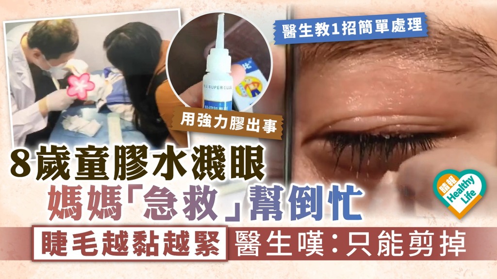 錯誤急救︳8歲童膠水濺眼媽媽「急救」幫倒忙 睫毛越黏越緊醫生嘆：只能剪掉