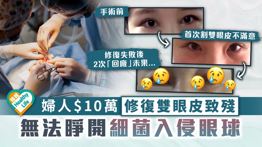 整容致殘︳婦人$10萬修復雙眼皮後致殘 無法睜開細菌入侵眼球2次「回廠」未果