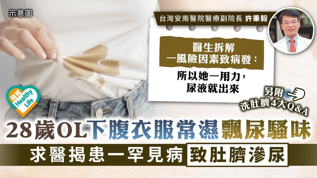 肚臍滲尿︳28歲OL下腹衣服常濕飄尿騷味 求醫揭患一罕見病致肚臍滲尿︳另附洗肚臍4大Q&A