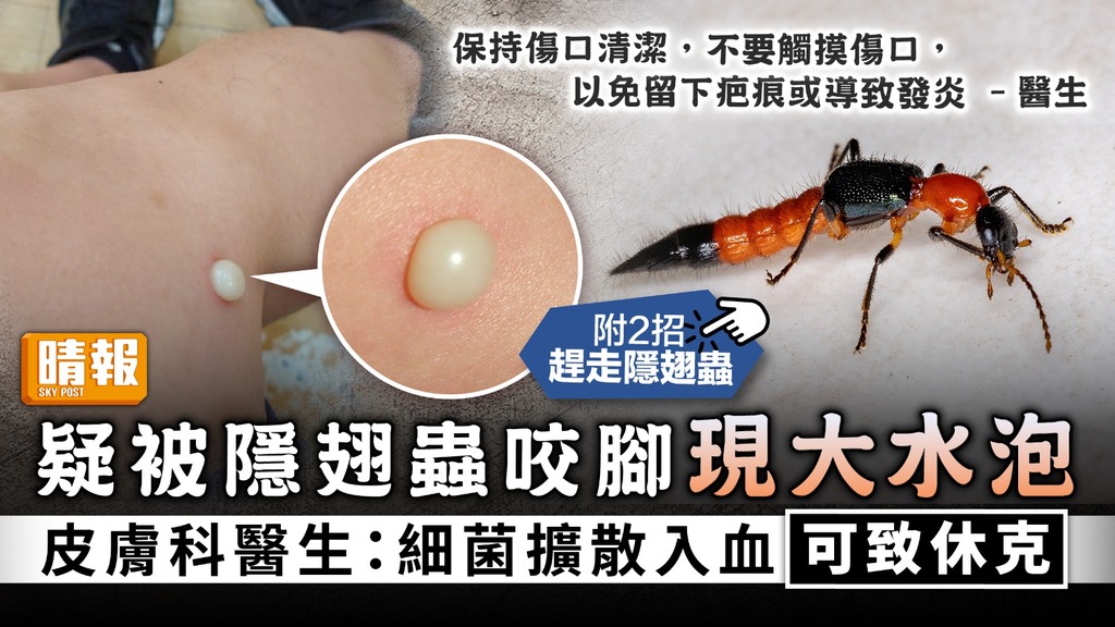 公園毒蟲｜疑被隱翅蟲咬腳現大水泡 皮膚科醫生：細菌擴散入血可致休克【2招趕走隱翅蟲】