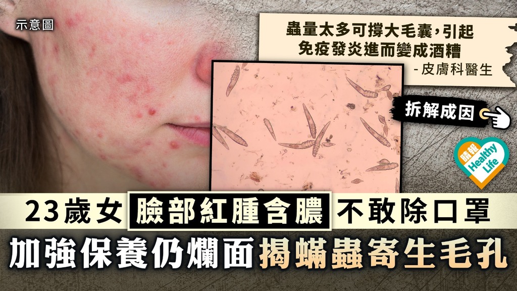 玫瑰痤瘡︳23歲女臉部紅腫含膿不敢除口罩 加強保養仍爛面揭蟎蟲寄生毛孔