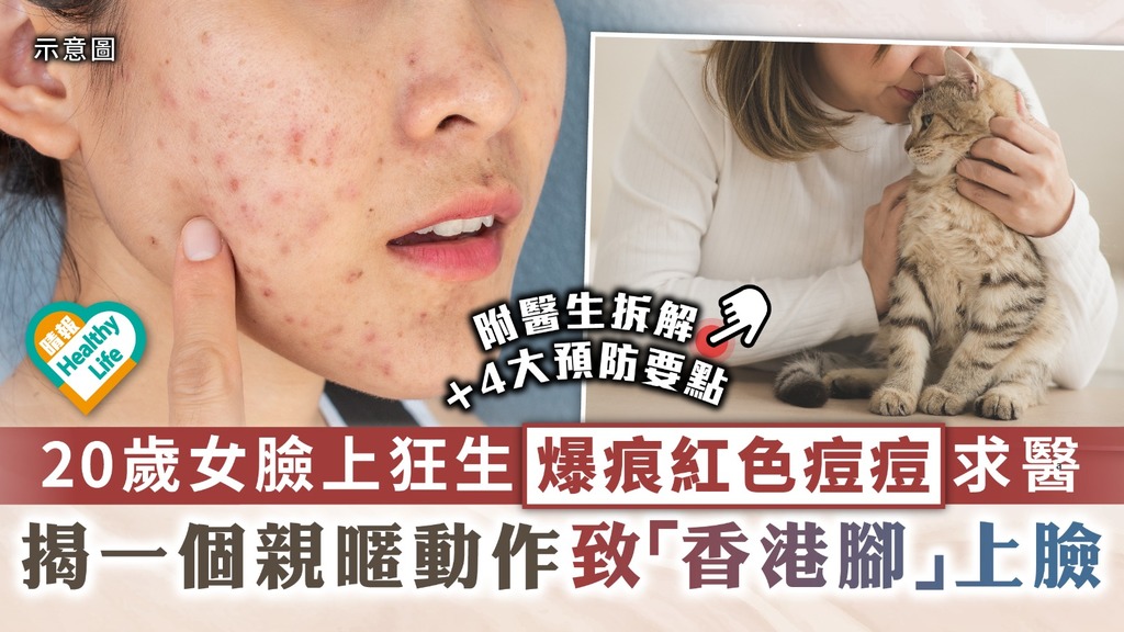 足癬︳20歲女臉上狂生爆痕紅色痘痘求醫 揭一個親暱動作致「香港腳」上臉︳4大預防要點