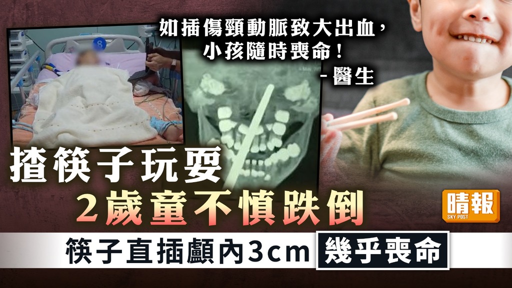家居意外 ︳揸筷子玩耍 2歲童不慎跌倒 筷子直插顱內3cm幾乎喪命