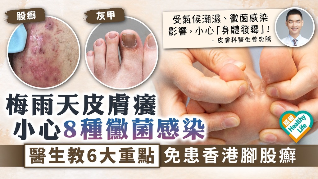 皮膚痕癢︳梅雨天皮膚癢小心8種黴菌感染 醫生教6大重點免患香港腳股癬