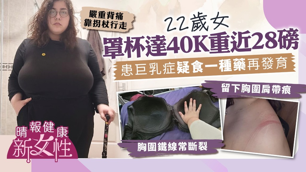 健康新女性︳胸部過大！22歲女罩杯達40K重近28磅 患巨乳症疑食一種藥再發育 嚴重背痛靠拐杖行走