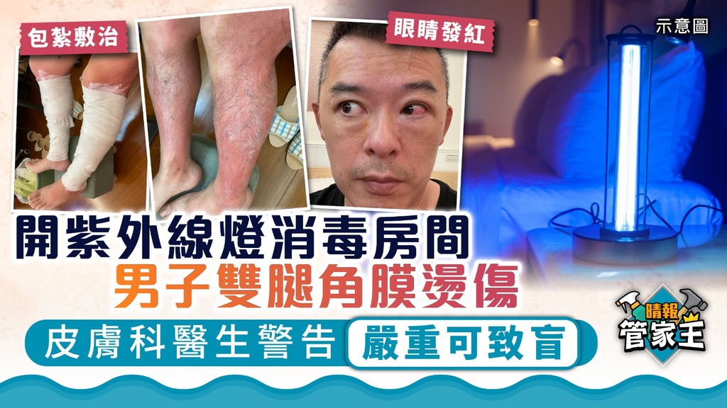 管家王 ︳男子開紫外線燈消毒房間致雙腿角膜燙傷 皮膚科醫生警告嚴重可致盲