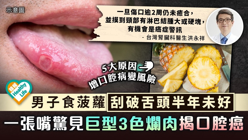 口腔破損︳男子食菠蘿刮破舌頭半年未好 一張嘴驚見巨型3色爛肉揭口腔癌︳附5大原因增口腔病變風險