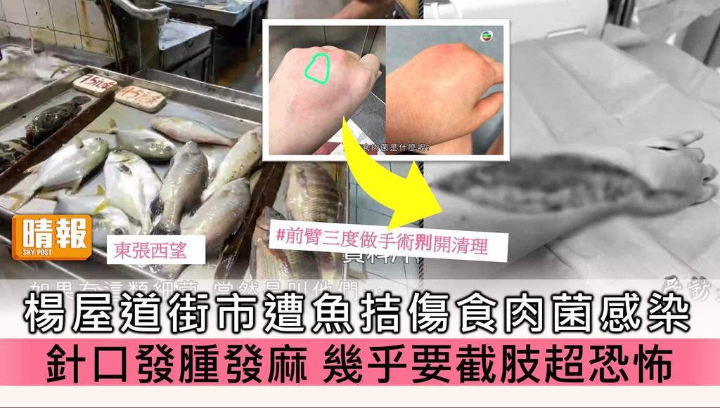 東張西望丨楊屋道街市遭魚拮傷慘變食肉菌感染 針口發腫發麻三度開刀幾乎要截肢超恐怖