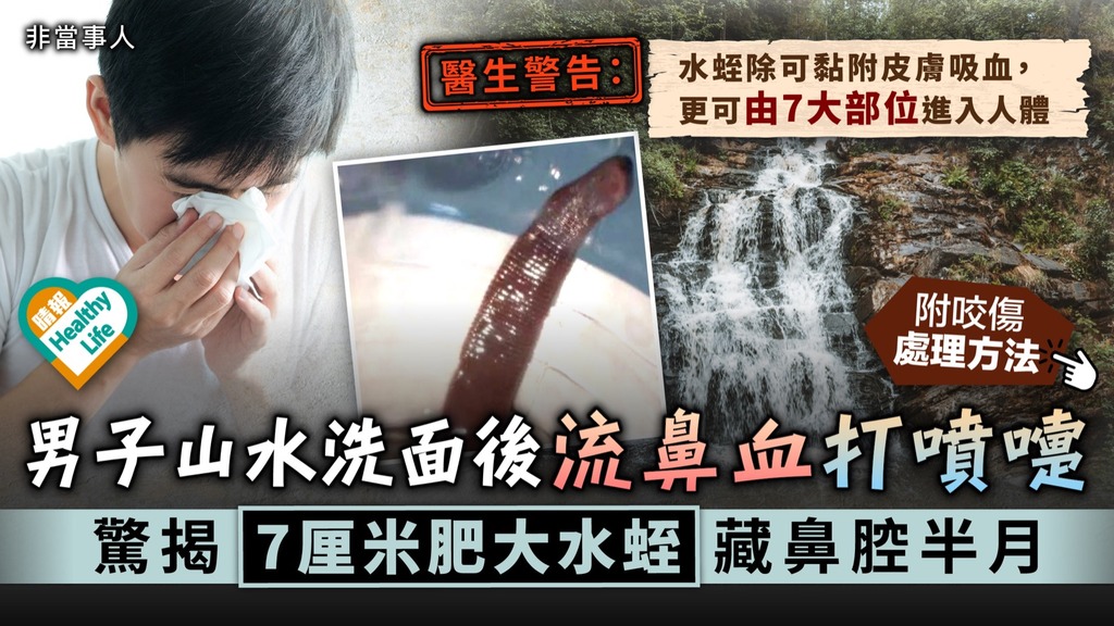 水蛭入鼻︳男子山水洗面後流鼻血打噴嚏 驚揭7厘米肥大水蛭藏鼻腔半月︳附醫生解說
