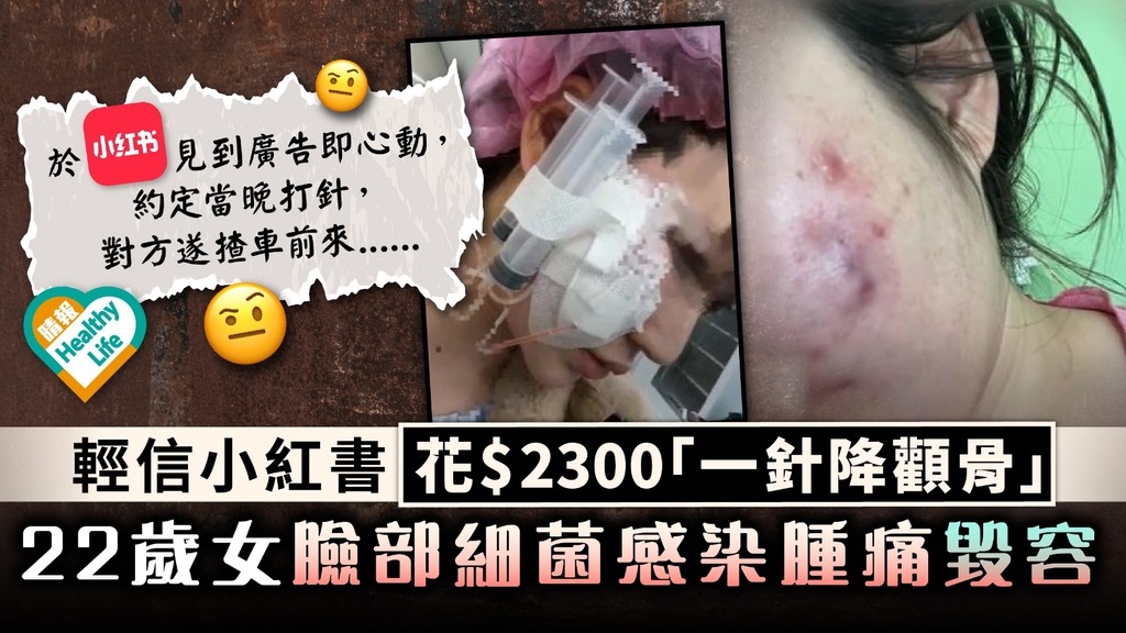 醫美意外︳輕信小紅書花$2300「一針降顴骨」 22歲女臉部細菌感染腫痛慘毀容