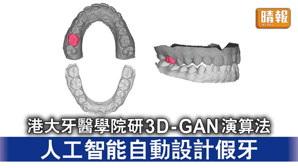 牙齒健康｜港大牙醫學院研3D-GAN演算法 人工智能自動設計假牙