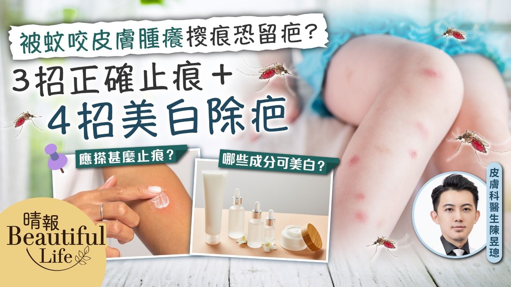 Beautiful Life︳夏天被蚊咬皮膚腫癢𢲷痕恐留疤？皮膚科醫生建議3招正確止痕︳附4招美白除疤