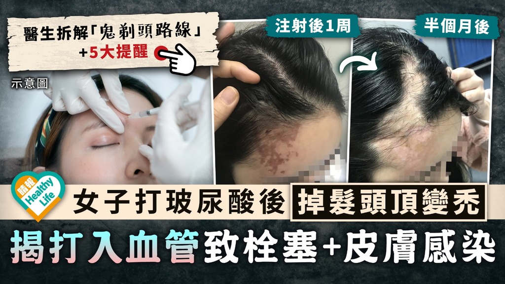 醫美毀容︳女子打玻尿酸後掉髮頭頂變禿 揭打入血管致栓塞+皮膚感染