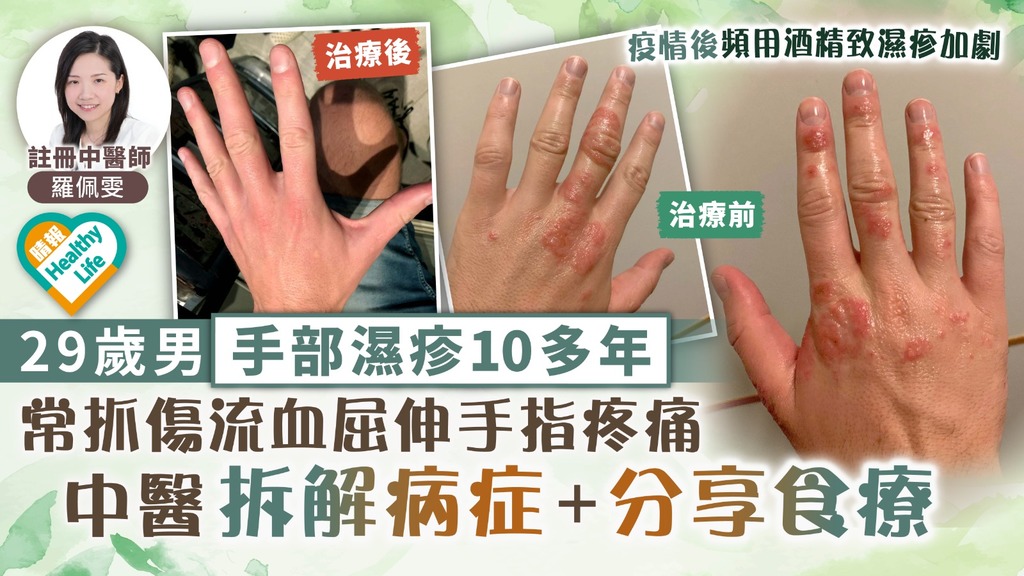 濕疹護理︳29歲男手部濕疹10多年 常抓傷流血屈伸手指疼痛 中醫拆解病症＋分享食療