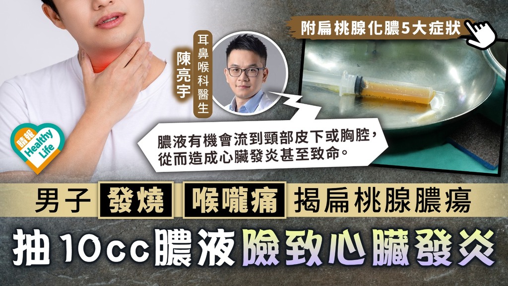 扁桃腺感染︳男子發燒喉嚨痛揭扁桃腺膿瘍 抽10cc膿液險致心臟發炎︳附扁桃腺化膿5大症狀