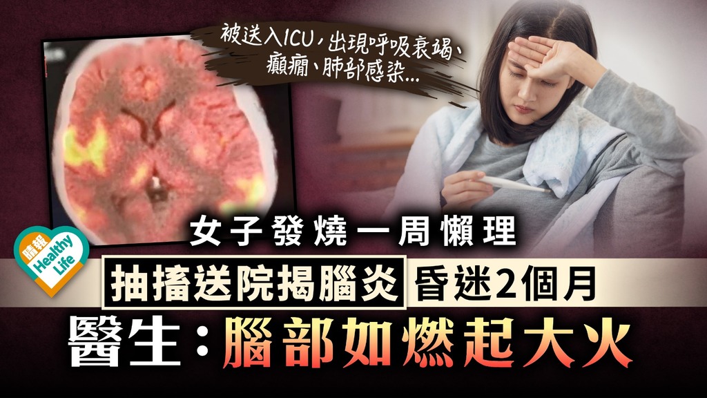 持續發燒︳女子發燒一周懶理 抽搐送院揭腦炎昏迷2個月 醫生：腦部如燃起大火