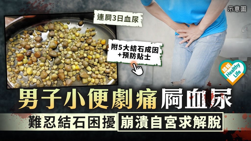 男人最痛︳男子小便劇痛痾血尿 難忍結石困擾崩潰自宮求解脫︳附5大結石成因+預防貼士