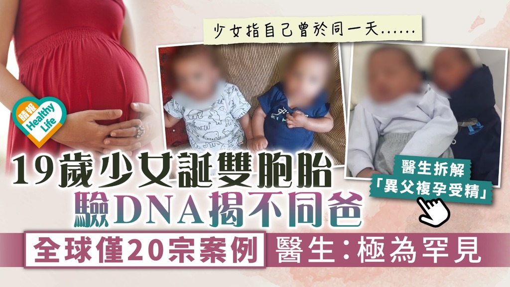 異父受精︳19歲少女誕雙胞胎驗DNA揭不同爸 全球僅20宗案例 醫生：極為罕見